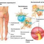 Как и чем лечить прострел в пояснице: причины острой боли, методы лечения