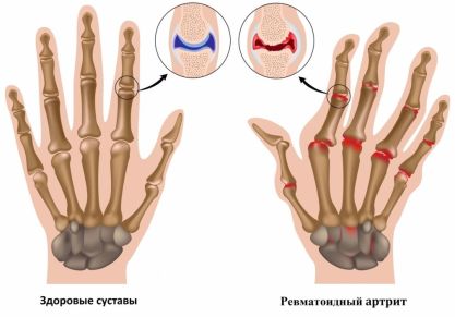 Диагностика ревматоидного артрита: дифференциальные, лабораторные и инструментальные методы