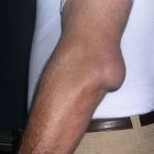 Бурсит локтевого сустава — лечение в домашних условиях народными средствами