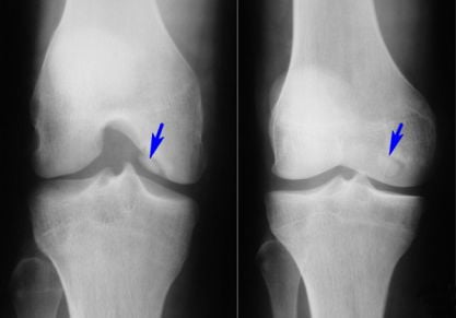 Остеоартрит коленного сустава: симптоматика и тактика терапии