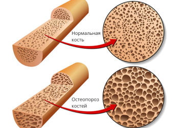 Медикаментозное и хирургическое лечение остеопороза поясничного отдела позвоночника