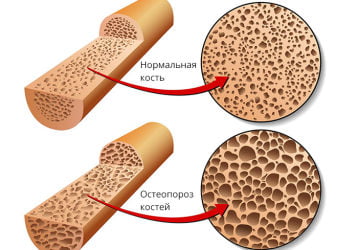 Лучшие препараты от остеопороза у женщин: список действующих веществ