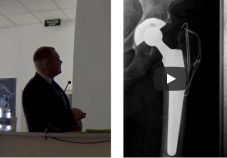 Видео: переломы проксимального отдела бедренной кости у пожилых пациентов. Сироткин А.В. (Ханты-Мансийск)