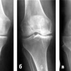 Остеоартроз коленного сустава: причины развития болезни, стадии, симптомы, как лечить недуг