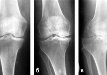 Остеоартроз коленного сустава: причины развития болезни, стадии, симптомы, как лечить недуг