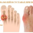 Как и чем лечить подагру на большом пальце ноги: медикаментозное и народное лечение, диета