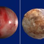 Список отличий артрита от артроза: разница симптомов и лечения