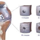 Гонартроз коленного сустава 1 степени: симптомы, диагностика и лечение заболевания