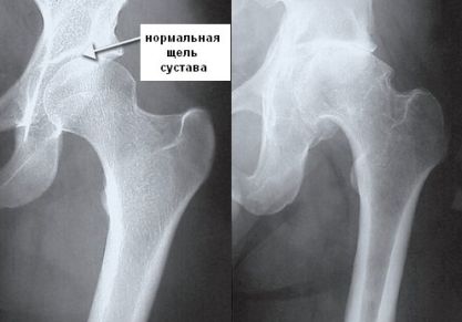 Самые эффективные упражнения при коксартрозе тазобедренного сустава