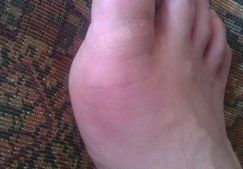 Причины и лечение воспаления сустава большого пальца ноги