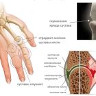 Лечение ревматоидного артрита в домашних условиях: эффективность народных средств