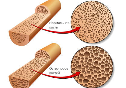 Самые эффективные препараты для лечения остеопороза: список названий