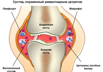 Гнойный артрит коленного и голеностопного суставов: симптомы и лечение