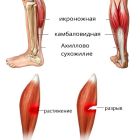 Что делать при растяжении мышц на ноге: симптомы травмирования, методики лечения