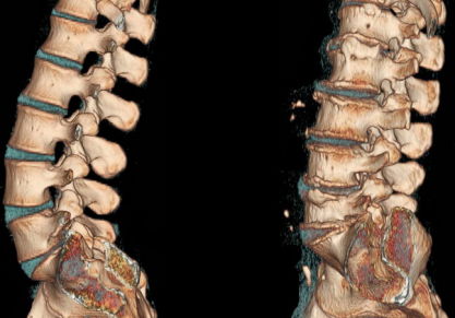 Остеохондроз — симптомы, лечение, признаки, полное описание заболевания
