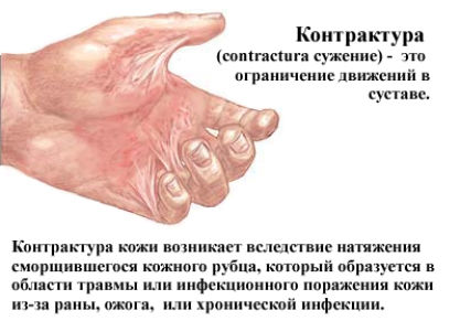 Какими бывают контрактуры и как с ними бороться: симптомы и методы лечения