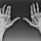 Артроз кисти рук и его лечение, причины и симптомы заболевания