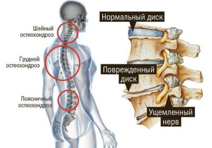 К какому врачу обратиться с остеохондрозом позвоночника