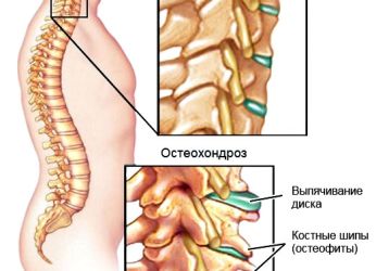 Виды ортопедических воротников для лечения шейного остеохондроза: показания и противопоказания, как использовать
