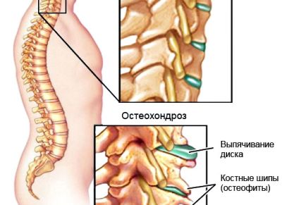 Виды ортопедических воротников для лечения шейного остеохондроза: показания и противопоказания, как использовать