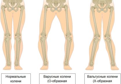 Вальгусная деформация коленных суставов у детей и взрослых