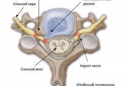 Унковертебральный артроз: что это и как правильно лечить?