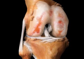 Полиартрит коленного сустава: симптомы и лечение