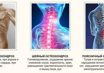 Обезболивающее при остеохондрозе: какие препараты лучше всего снимают боль?