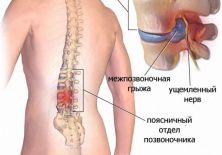 Причины и разновидности дорзальной грыжи диска — диагностика и лечение