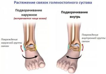 Растяжение связок голеностопного сустава: лечение, причины, симптомы, полное описание травмы