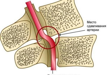Симптомы и лечение синдрома позвоночной артерии при шейном остеохондрозе