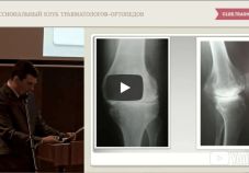 Видео: эндопротезирование коленного сустава с использованием лазерной навигации. Житенев М.И. (Воронеж)
