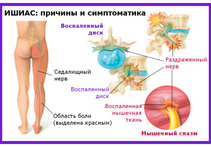 Рецепты народной медицины для лечения ишиаса в домашних условиях