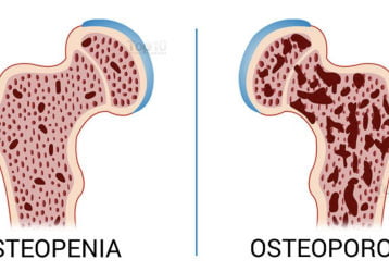 Разница между остеопенией и остеопорозом: список отличий