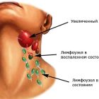 Боли в шейных лимфоузлах: причины, симптомы и лечение