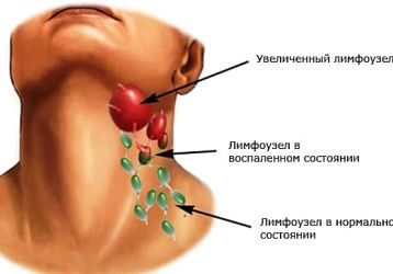 Боли в шейных лимфоузлах: причины, симптомы и лечение