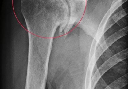 Как лечить артроз плечевого сустава в домашних условиях народными средствами