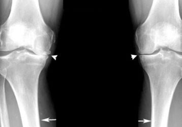 Правда о лечении остеоартроза коленного сустава 3 степени: стоит ли откладывать операцию?