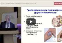 Видео презентация на тему переломов проксимального отдела большеберцовой кости. И.Г. Беленький (С-Петербург)