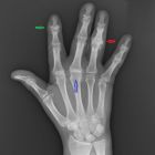 Узелки Гебердена и Бушара: симптомы, диагностика и лечение