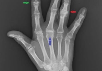 Полиартрит пальцев рук: симптомы, диагностика, лечение, полное описание недуга
