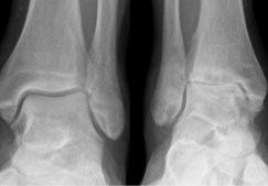 Народные средства в терапии остеоартроза голеностопного сустава: рецепты мазей, растирок, компрессов