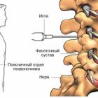 Эффективные уколы для лечения остеохондроза поясничного отдела позвоночника