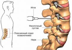 Эффективные уколы для лечения остеохондроза поясничного отдела позвоночника