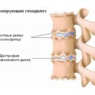 Деформирующий спондилез шейного отдела позвоночника