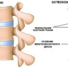 Почему возникает межпозвонковый остеохондроз: причины, симптомы, лечение болезни