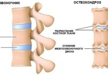 Почему возникает межпозвонковый остеохондроз: причины, симптомы, лечение болезни