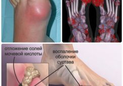 Подагра на ногах: тенденции в диагностике и лечении патологии