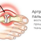 Все способы лечения артрита стопы в домашних условиях