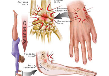 Симптомы и методы лечения вывихов кисти руки: вправление и открытая хирургия
